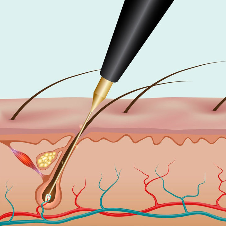 electrolysis